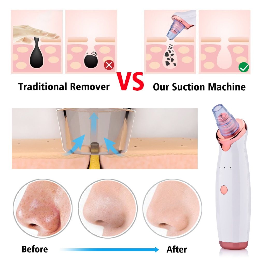 Electric Blackhead Remover – Powerful Suction Facial Cleanser for Acne & Pore Care